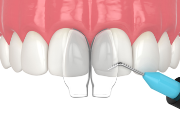 Composite_bonding-service