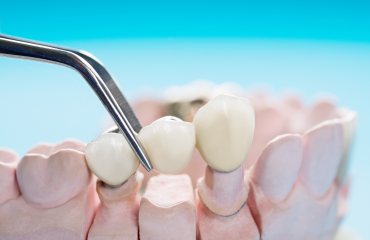 Fixed_dental_prosthesis-service
