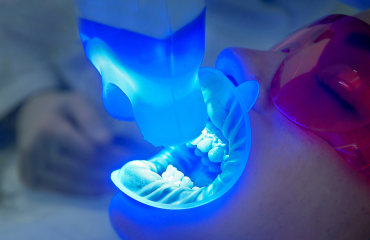 Teeth_Whitening-service