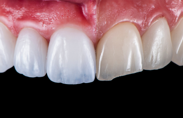 Veneers-service