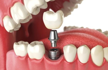 dental_implant-service